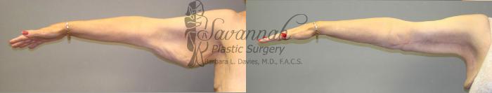 Before & After Arm Lift Case 41 View 1 View in Savannah, Georgia