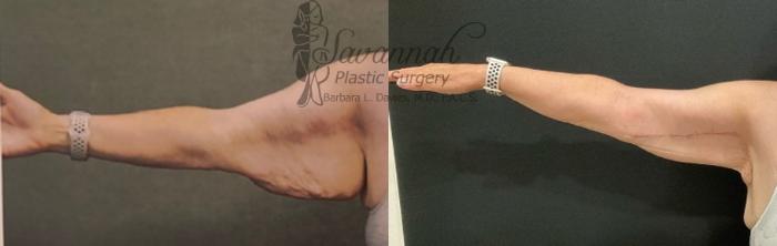 Before & After Arm Lift Case 85 Front View in Savannah, Georgia