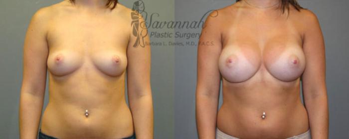 Before & After Breast Augmentation Case 13 View 1 View in Savannah, Georgia