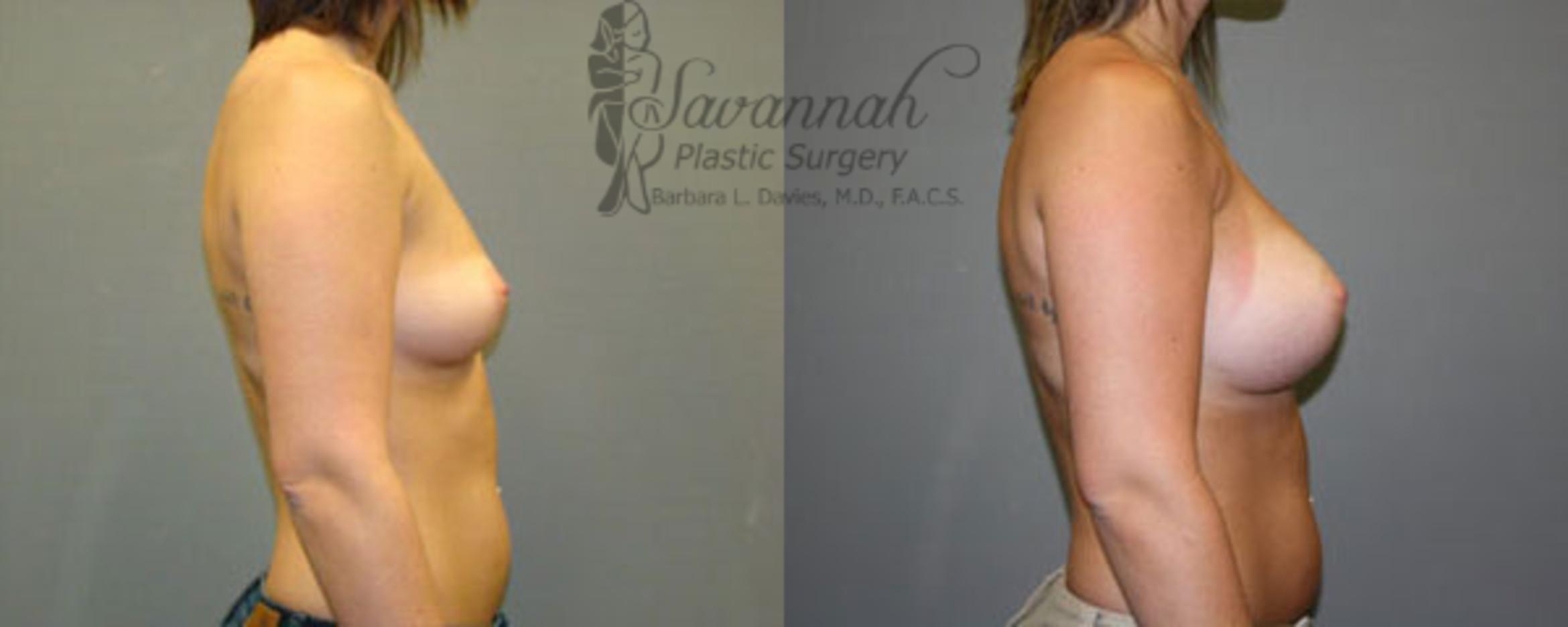 Before & After Breast Augmentation Case 13 View 2 View in Savannah, Georgia