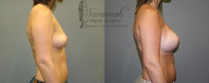 Before & After Breast Augmentation Case 13 View 2 View in Savannah, Georgia