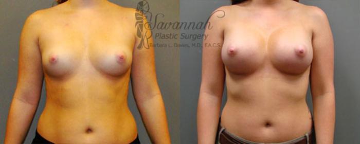 Before & After Breast Augmentation Case 15 View 1 View in Savannah, Georgia