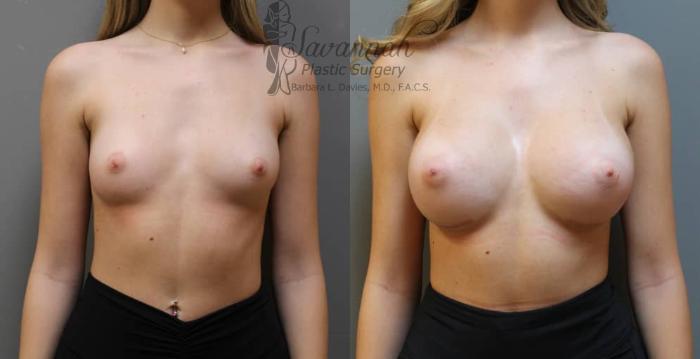 Before & After Breast Augmentation Case 2 View 1 View in Savannah, Georgia