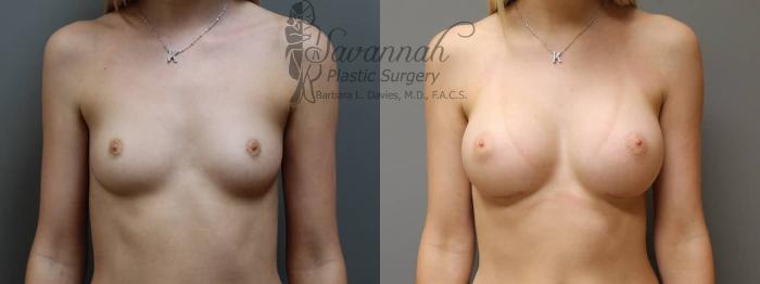 Before & After Breast Augmentation Case 3 View 1 View in Savannah, Georgia