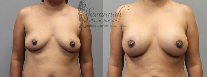 Before & After Breast Augmentation Case 4 View 1 View in Savannah, Georgia