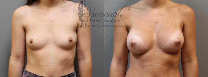 Before & After Breast Augmentation Case 5 View 1 View in Savannah, Georgia