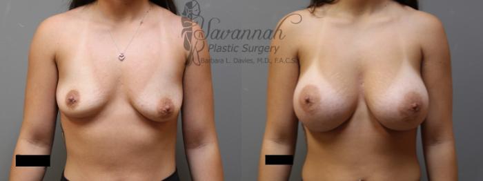 Before & After Breast Augmentation Case 6 View 1 View in Savannah, Georgia