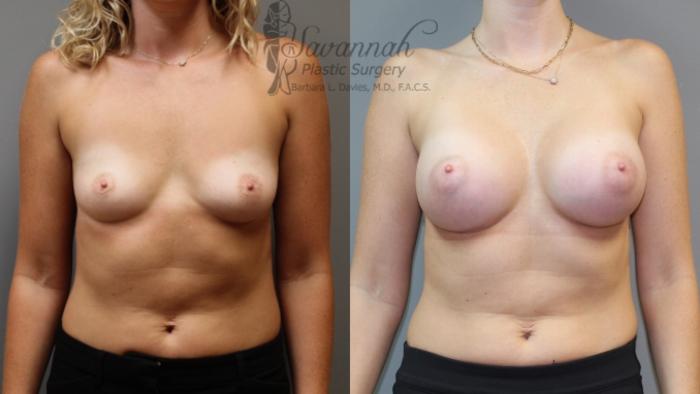 Before & After Breast Augmentation Case 7 View 1 View in Savannah, Georgia