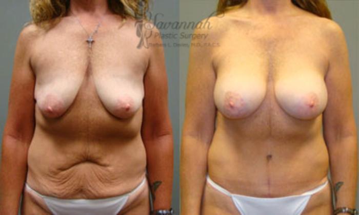 Before & After Tummy Tuck Case 8 View 1 View in Savannah, Georgia