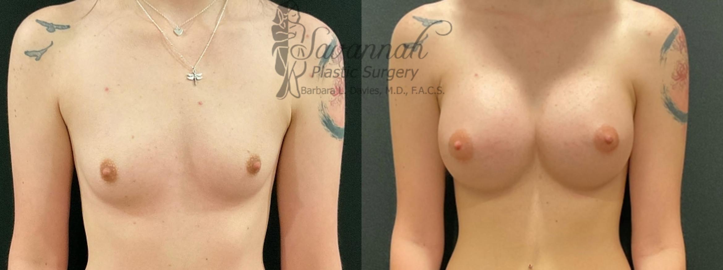 Before & After Breast Augmentation Case 88 Front View in Savannah, Georgia