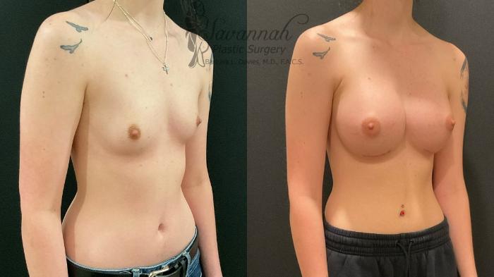 Before & After Breast Augmentation Case 88 Right Oblique View in Savannah, Georgia