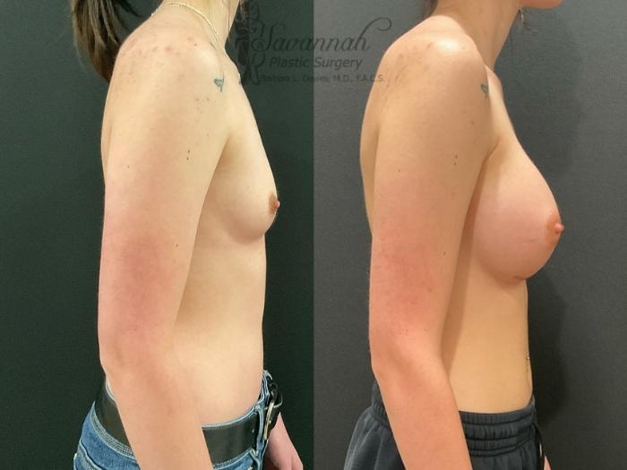 Before & After Breast Augmentation Case 88 Right Side View in Savannah, Georgia