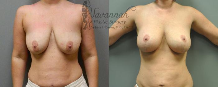 Before & After Breast Lift Case 18 View 1 View in Savannah, Georgia