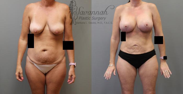 Before & After Liposuction Case 19 View 1 View in Savannah, Georgia