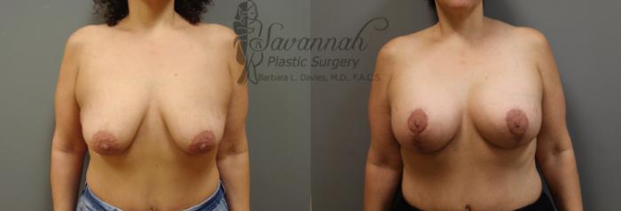 Before & After Breast Lift Case 20 View 1 View in Savannah, Georgia