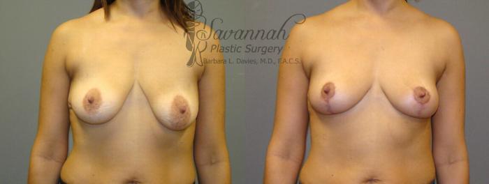 Before & After Breast Lift Case 21 View 1 View in Savannah, Georgia
