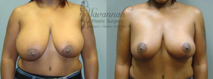 Before & After Breast Reduction Case 24 View 1 View in Savannah, Georgia