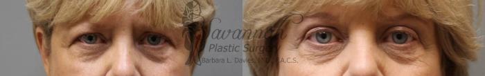 Before & After Eyelid Surgery Case 62 View 1 View in Savannah, Georgia