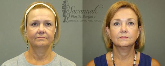 Before & After FreshLook Lift® Case 63 View 1 View in Savannah, Georgia