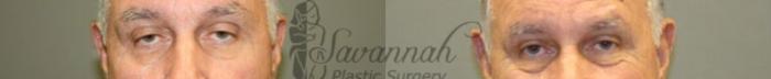 Before & After Eyelid Surgery Case 64 View 1 View in Savannah, Georgia