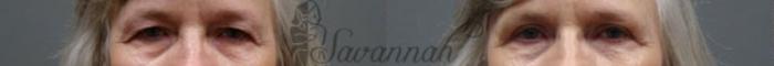 Before & After Eyelid Surgery Case 65 View 1 View in Savannah, Georgia
