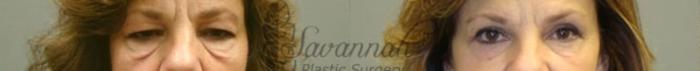 Before & After Eyelid Surgery Case 66 View 1 View in Savannah, Georgia