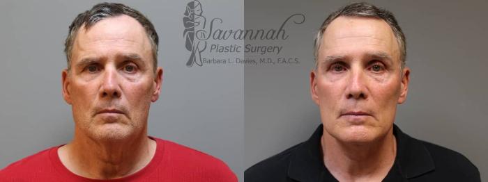 Before & After FreshLook Lift® Case 69 View 1 View in Savannah, Georgia