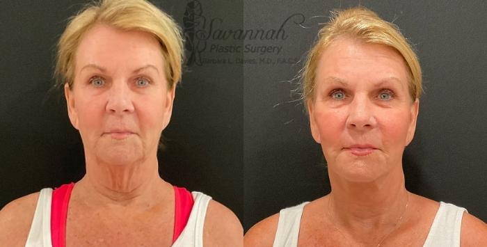 Before & After FreshLook Lift® Case 87 Front View in Savannah, Georgia