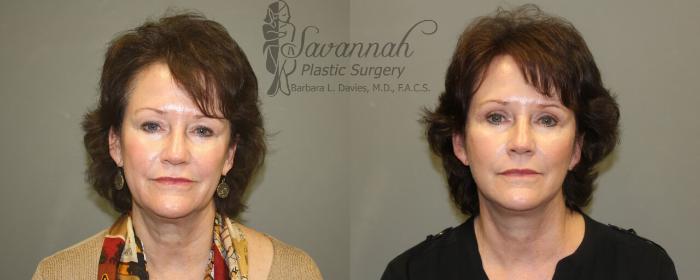 Before & After FreshLook Lift® Case 72 View 1 View in Savannah, Georgia