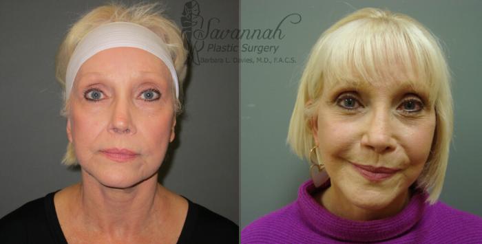Before & After FreshLook Lift® Case 75 View 1 View in Savannah, Georgia