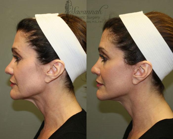 Before & After FreshLook Lift® Case 78 View 1 View in Savannah, Georgia