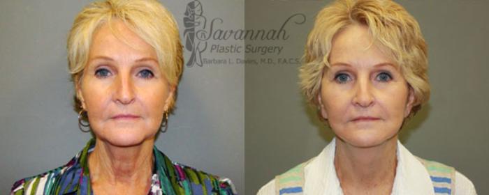 Before & After FreshLook Lift® Case 79 View 1 View in Savannah, Georgia