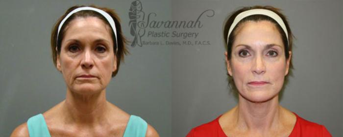 Before & After FreshLook Lift® Case 80 View 1 View in Savannah, Georgia