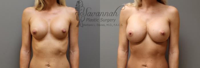 Before & After Implant Exchange Case 1 View 1 View in Savannah, Georgia