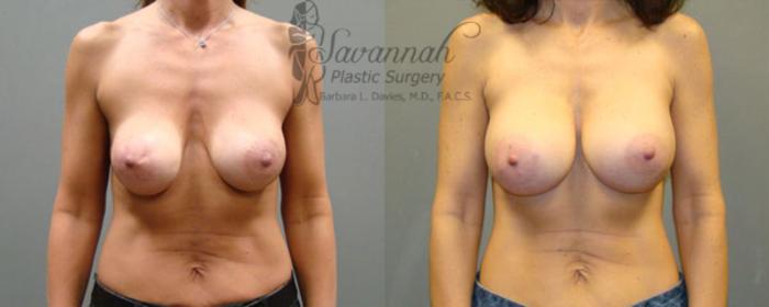 Before & After Implant Exchange Case 14 View 1 View in Savannah, Georgia