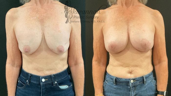 Before & After Implant Exchange Case 92 Front View in Savannah, Georgia