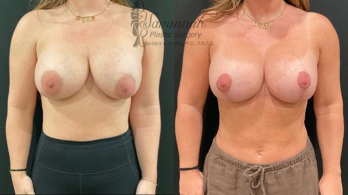 Before & After Implant Exchange Case 98 Front View in Savannah, Georgia