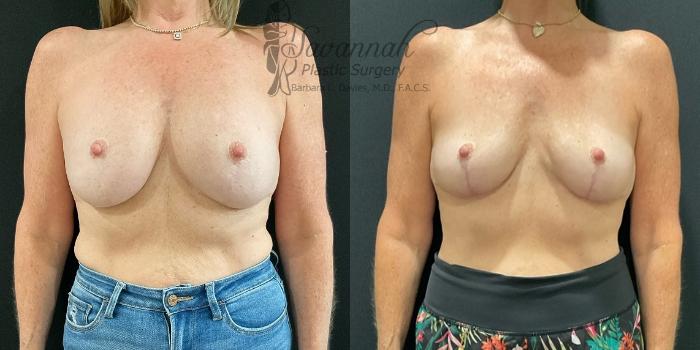Before & After Breast Lift Case 89 Front View in Savannah, Georgia