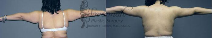 Before & After Liposuction Case 40 View 1 View in Savannah, Georgia