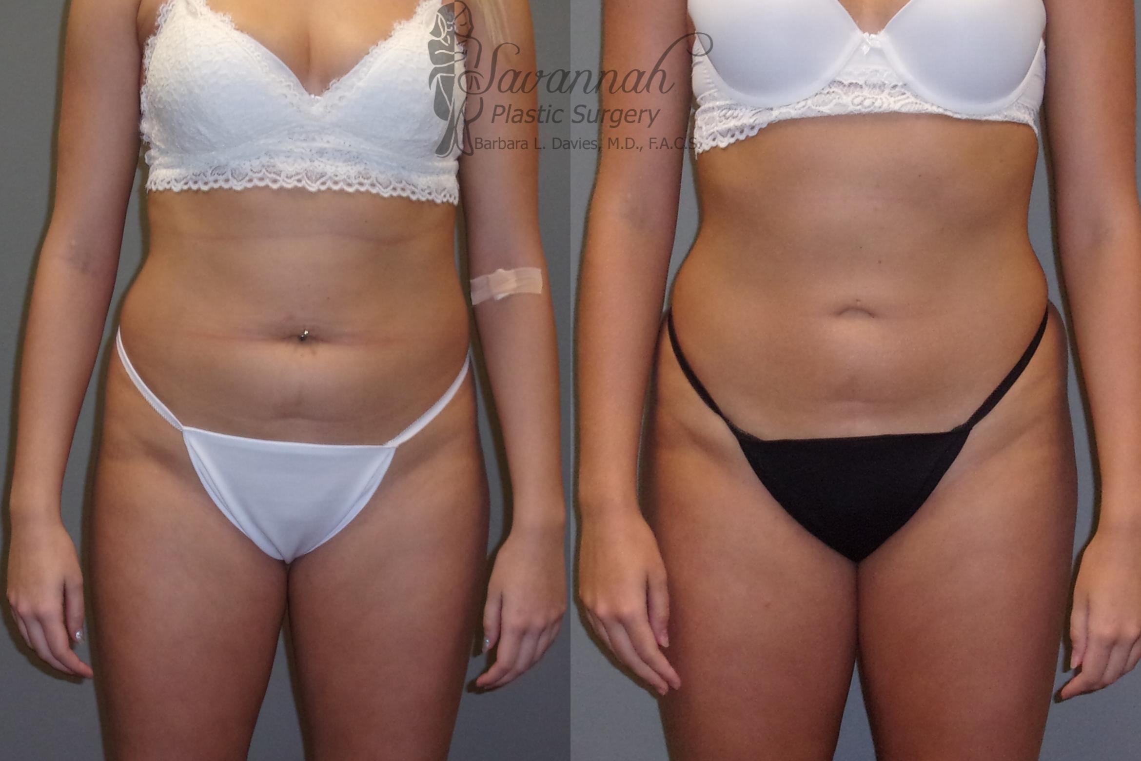 Before & After Liposuction Case 43 View 1 View in Savannah, Georgia