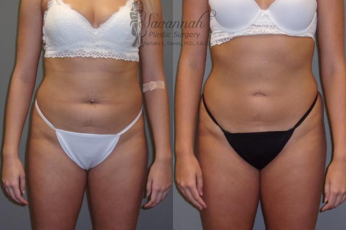 Before & After Liposuction Case 43 View 1 View in Savannah, Georgia