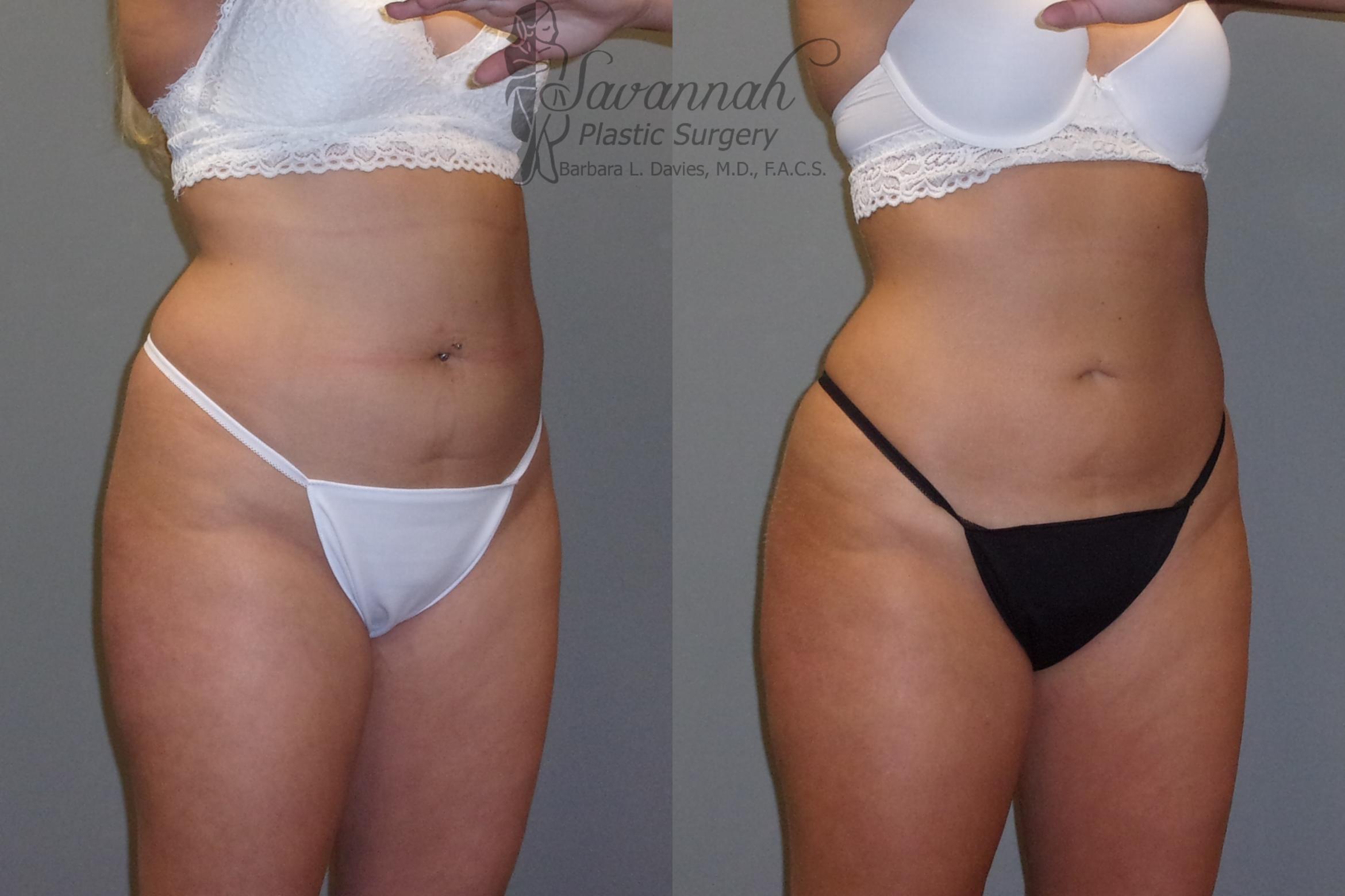 Before & After Liposuction Case 43 View 2 View in Savannah, Georgia