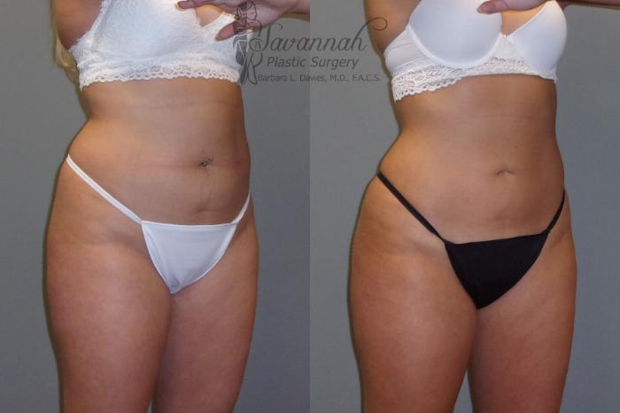Before & After Liposuction Case 43 View 2 View in Savannah, Georgia