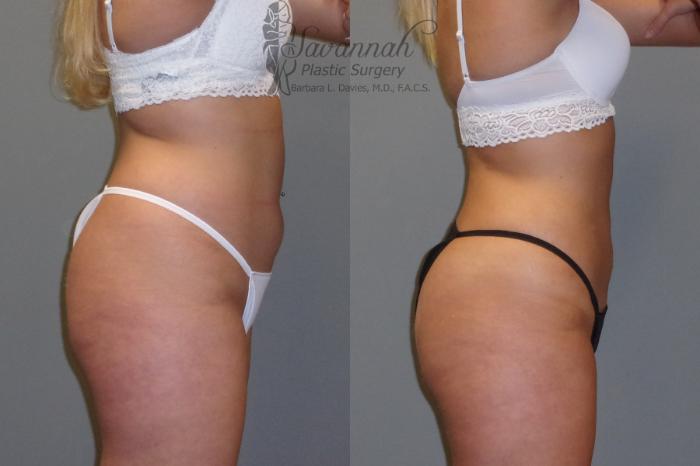 Before & After Liposuction Case 43 View 3 View in Savannah, Georgia