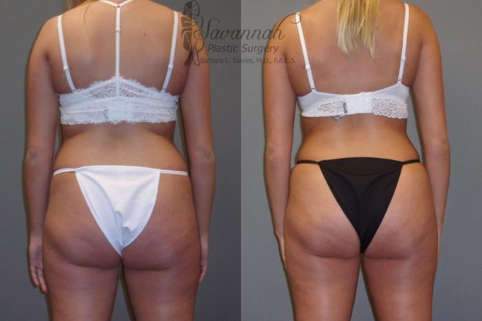 Before & After Liposuction Case 43 View 4 View in Savannah, Georgia