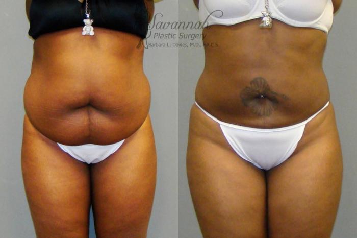 Before & After Liposuction Case 44 View 1 View in Savannah, Georgia