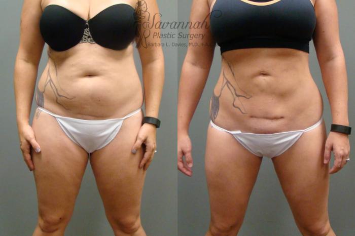 Before & After Liposuction Case 46 View 1 View in Savannah, Georgia