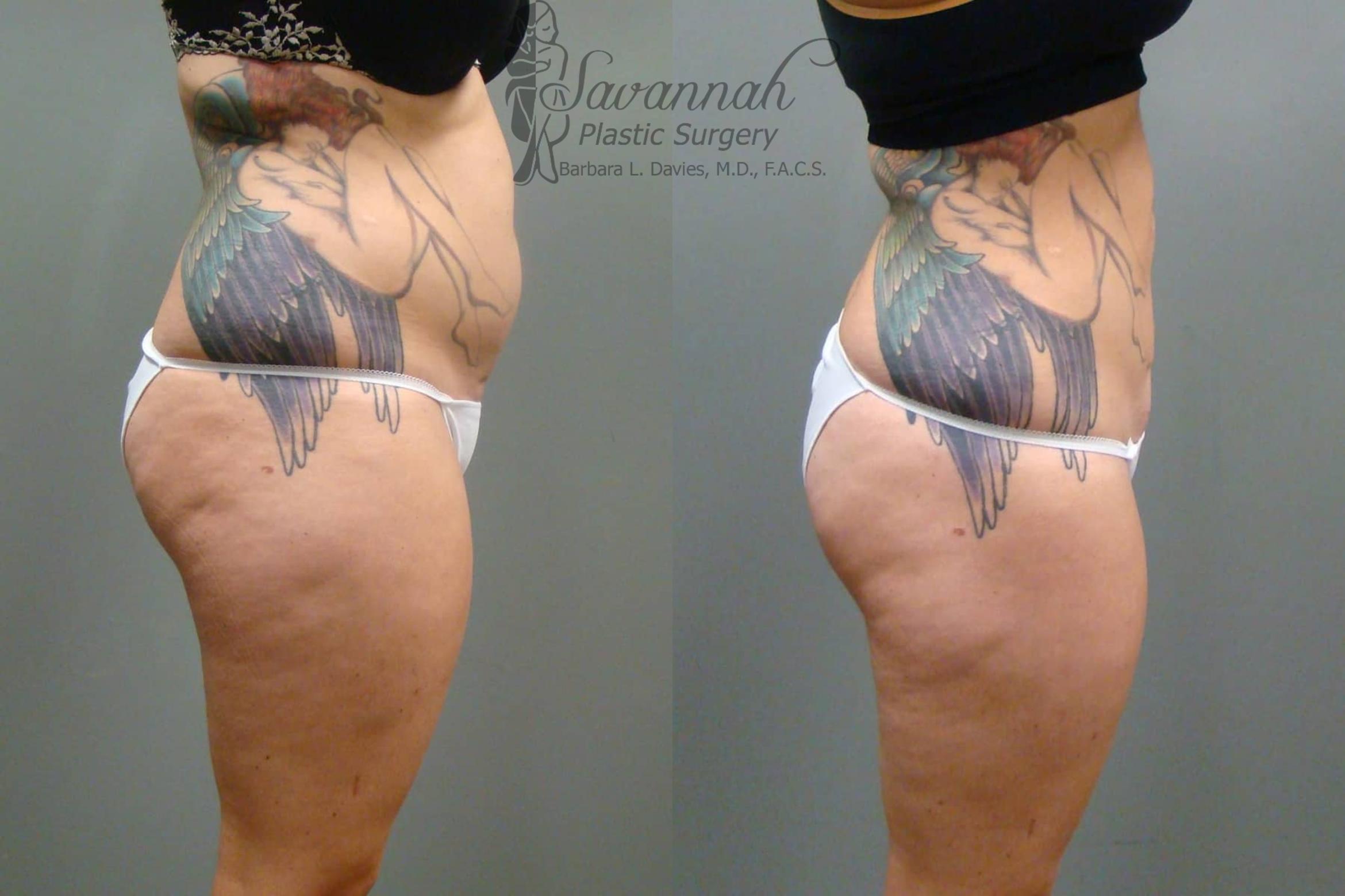 Before & After Liposuction Case 46 View 3 View in Savannah, Georgia