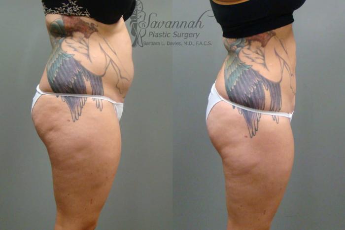 Before & After Liposuction Case 46 View 3 View in Savannah, Georgia