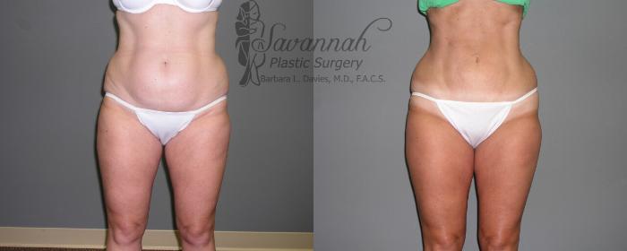 Before & After Liposuction Case 49 View 1 View in Savannah, Georgia